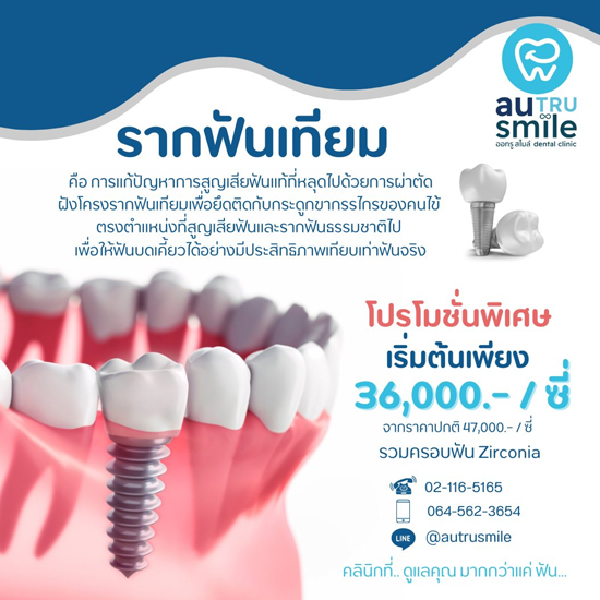 โปรโมชั่นทำรากฟันเทียม